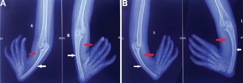 X-ray images of bilateral hands and forearm. (A) right hand and forearm in two different views showing bowing of ulnar bone (white arrows), absence of radius (red arrow) and absence of thumb and (B) left hand and forearm in two different views showing bowing of ulnar bone (white arrows), absence of radius (red arrow) and absence of thumb.